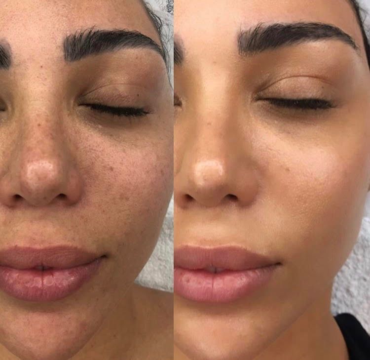 Dull Skin